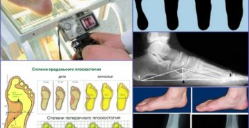 Годен если плоскостопие 1 и 2 степени